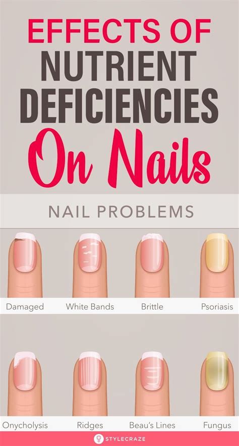 nail problems and vitamin deficiencies.